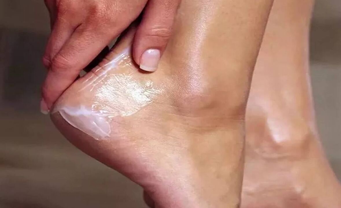 Kako zdraviti glive za noge s kremo z glivo