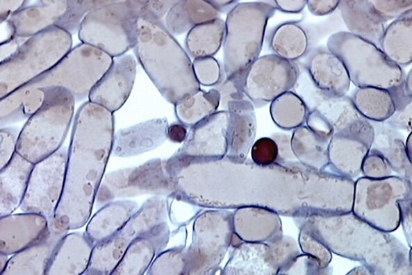 celice glivic na nohtih pod mikroskopom