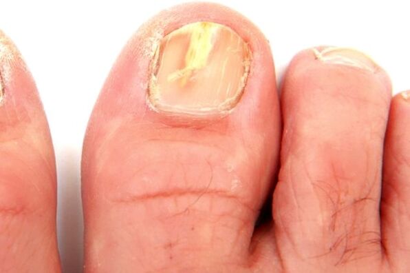 poškodba nohtne plošče zaradi glivične okužbe